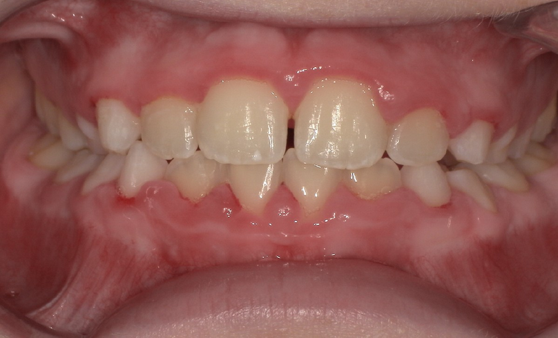 After treatment