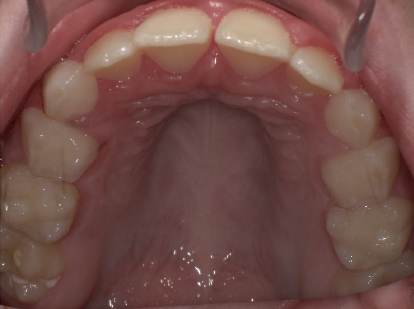 After treatment