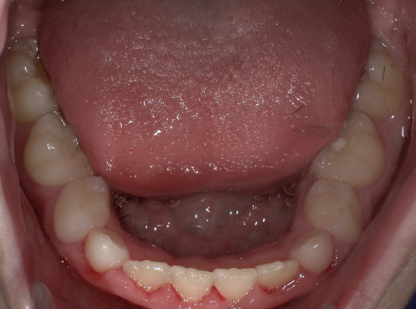 After treatment