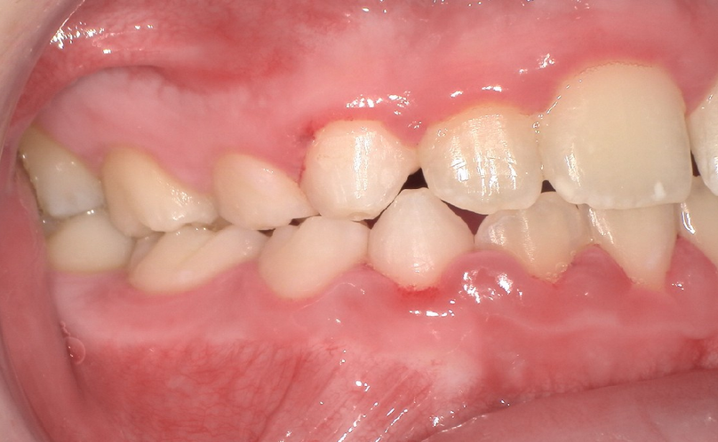 After treatment