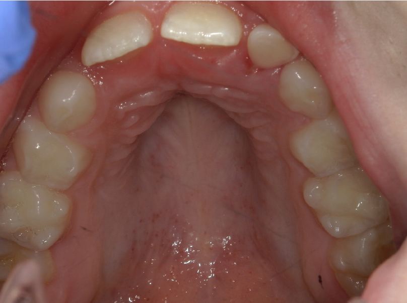 Before treatment