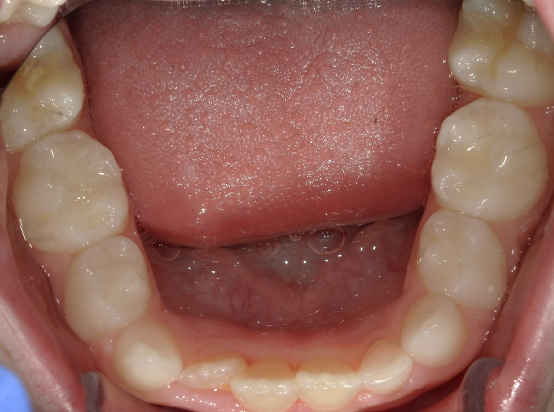 Before treatment