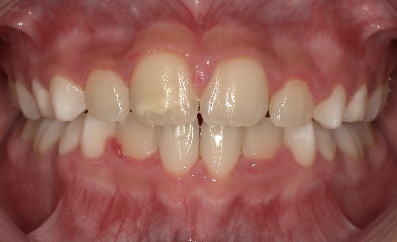 After treatment