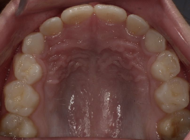After treatment