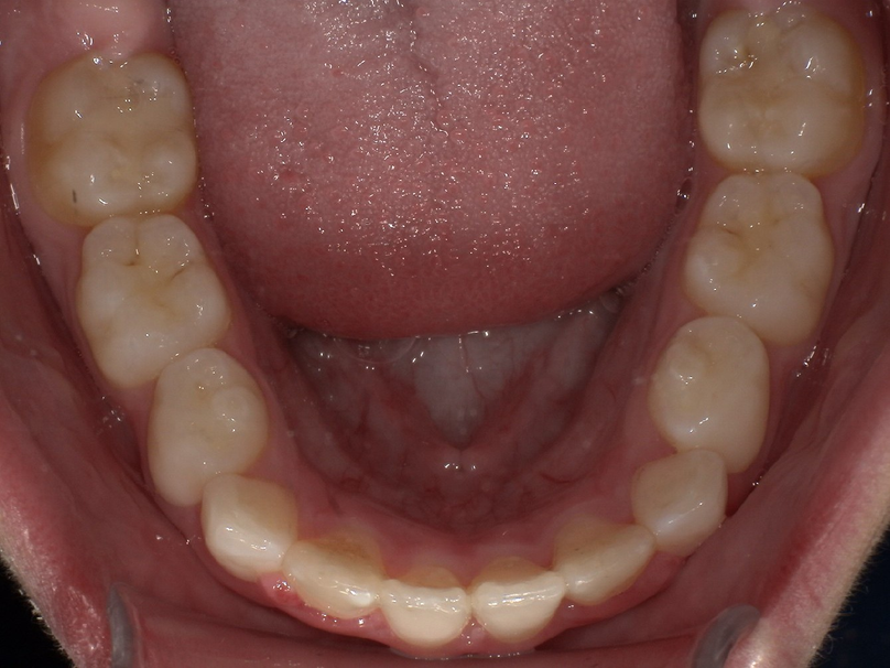 After treatment