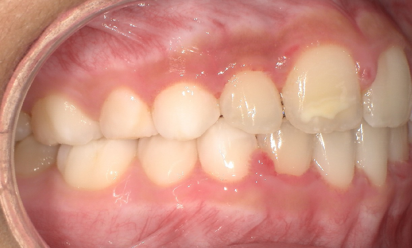 After treatment
