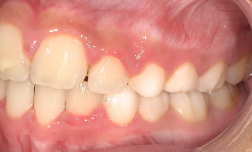 After treatment