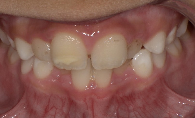 Before treatment