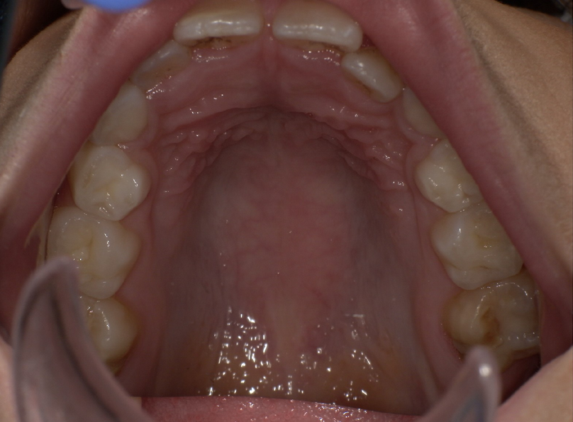 Before treatment