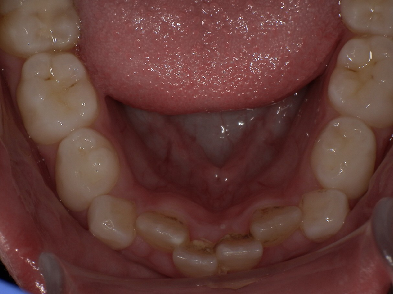 Before treatment