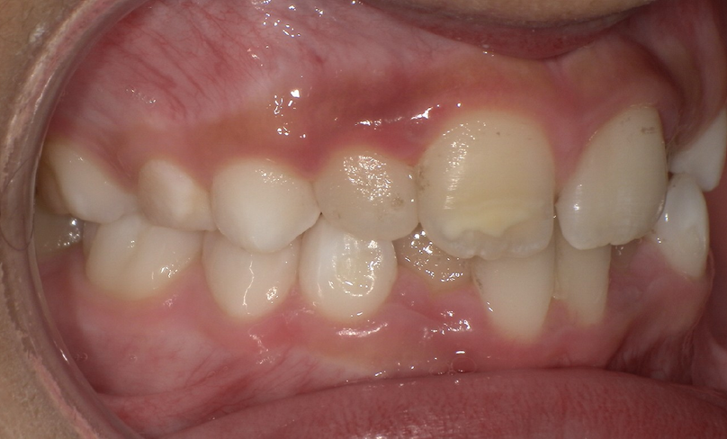 Before treatment