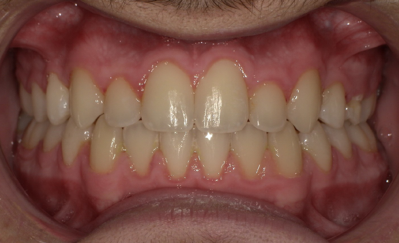 After treatment