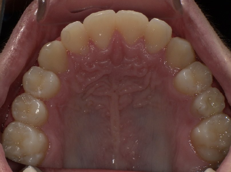 After treatment