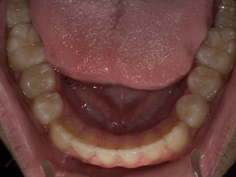 After treatment