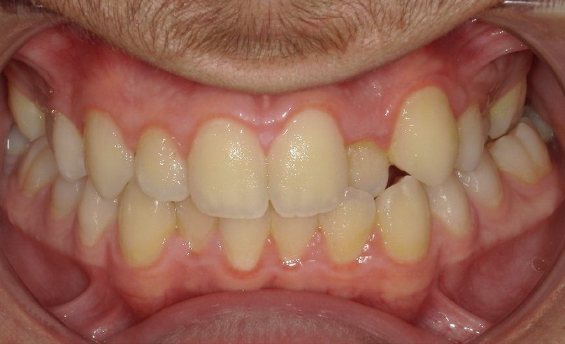 Before treatment