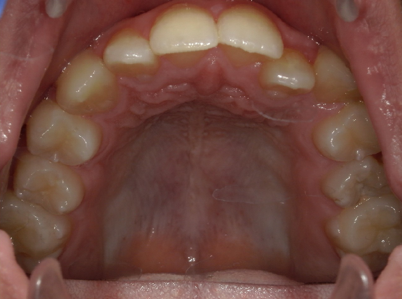 Before treatment