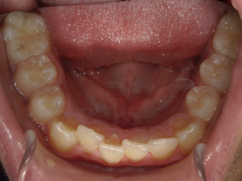 Before treatment