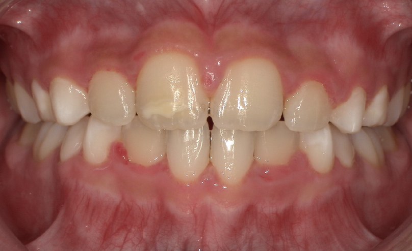 After treatment