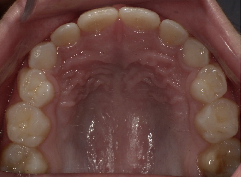 After treatment
