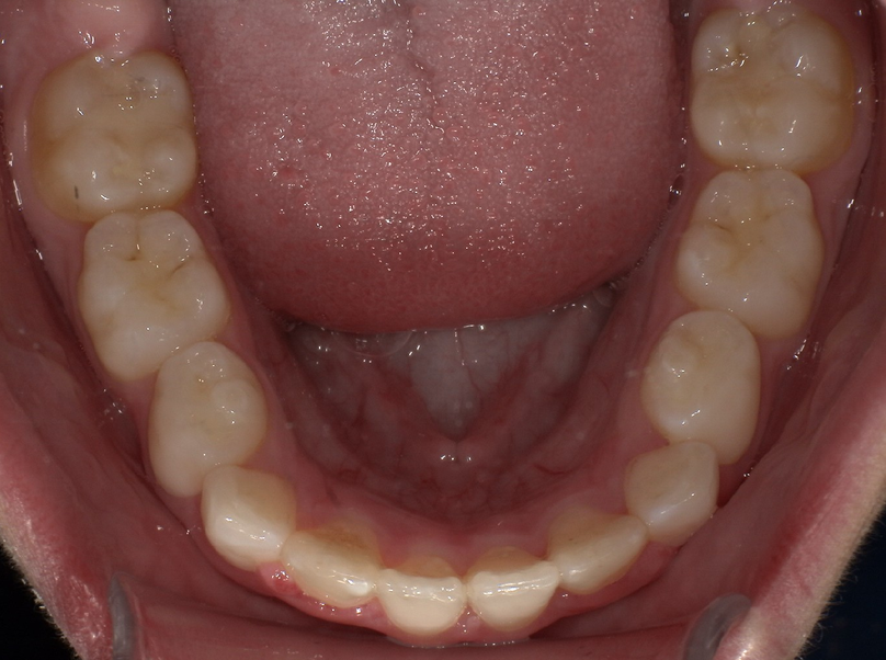 After treatment