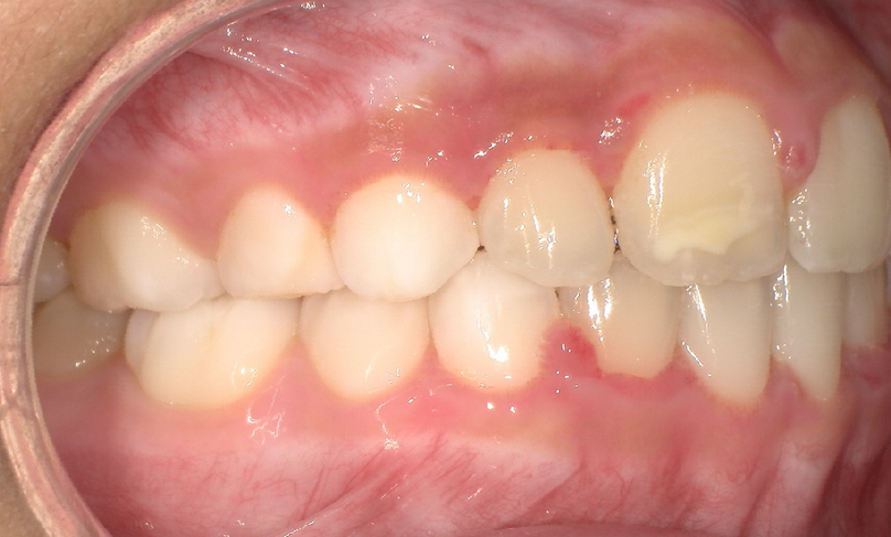After treatment