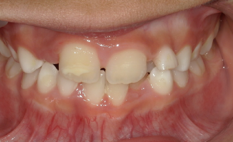 Before treatment