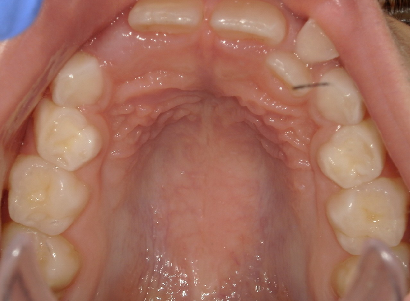 Before treatment