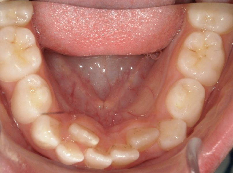 Before treatment