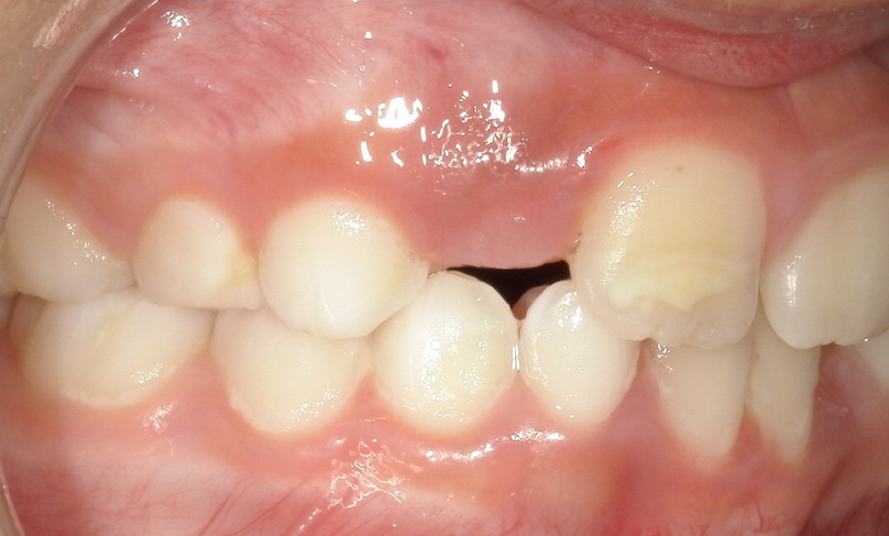 Before treatment