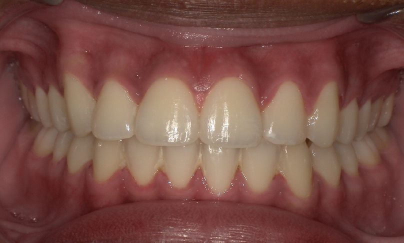 After treatment