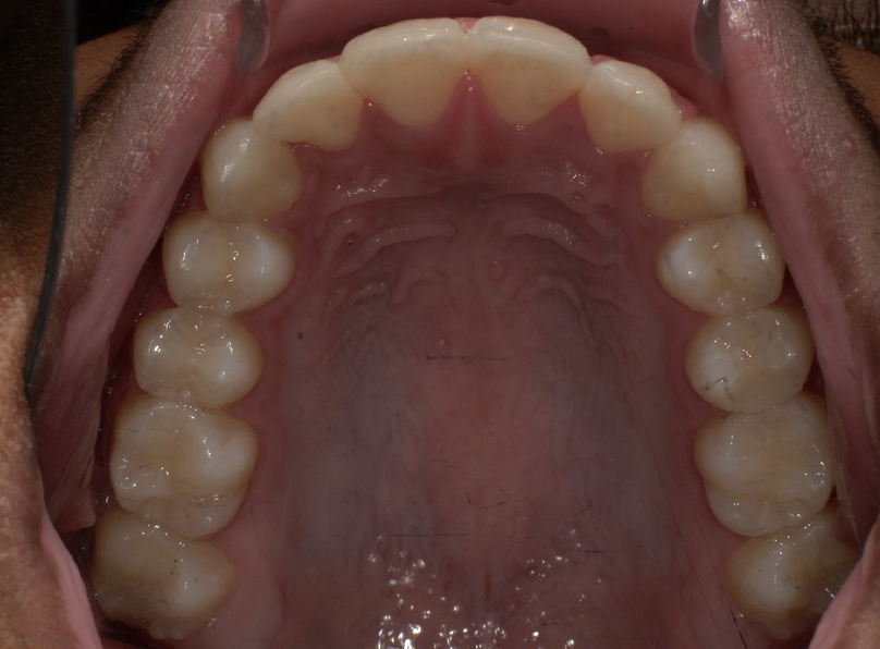 After treatment