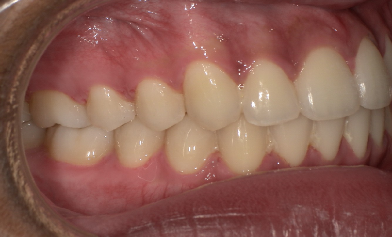 After treatment