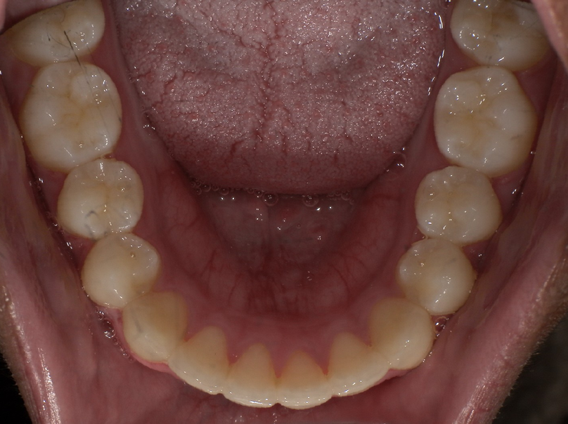 After treatment