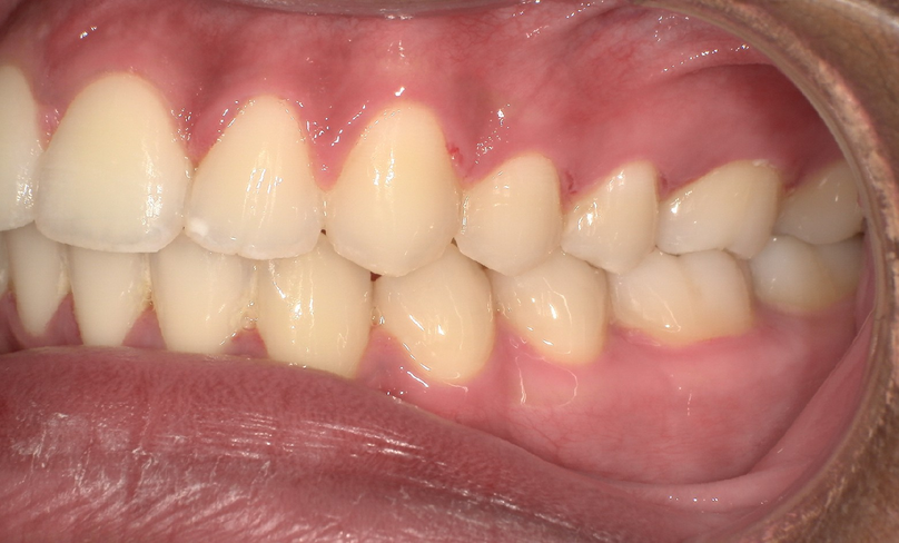 After treatment