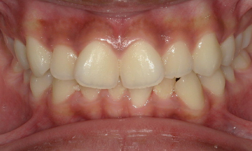 Before treatment
