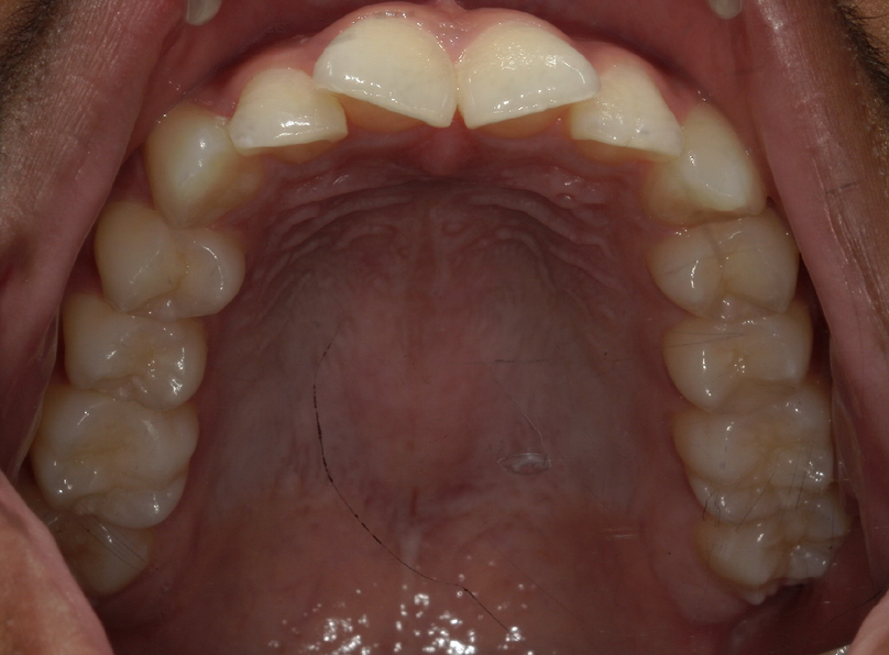 Before treatment