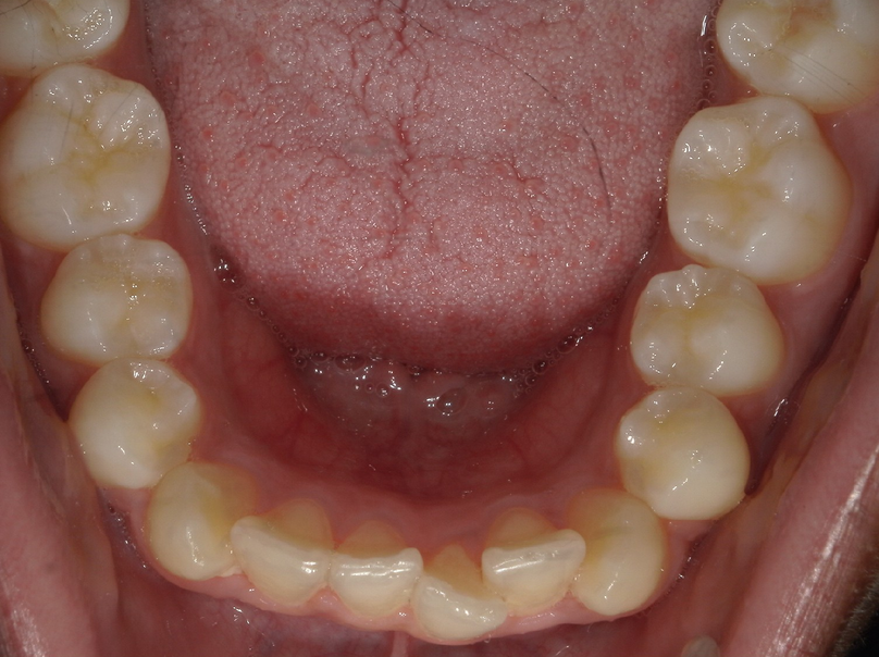 Before treatment
