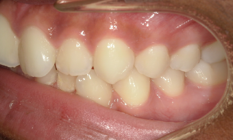 Before treatment