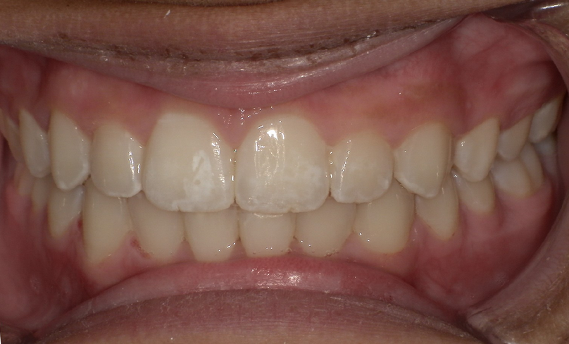 After treatment
