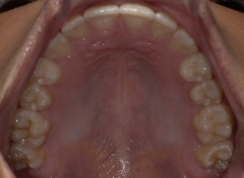 After treatment
