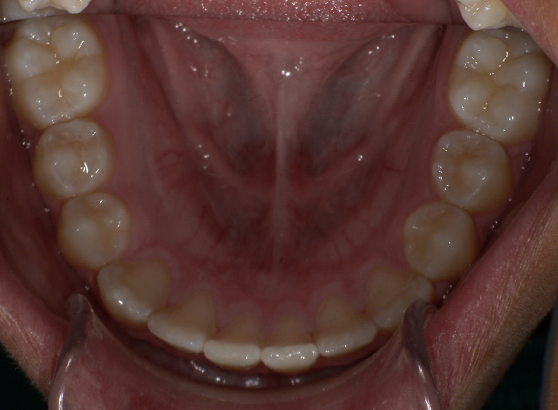 After treatment