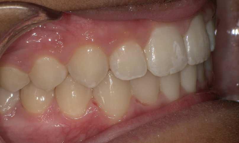 After treatment