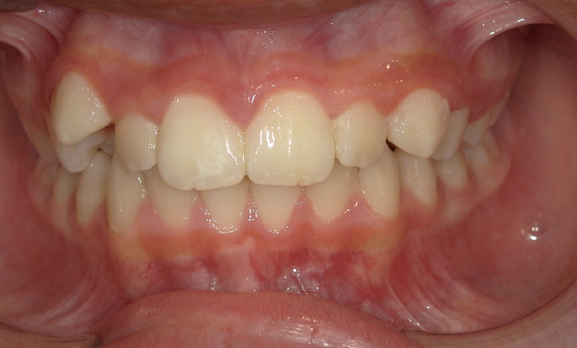Before treatment