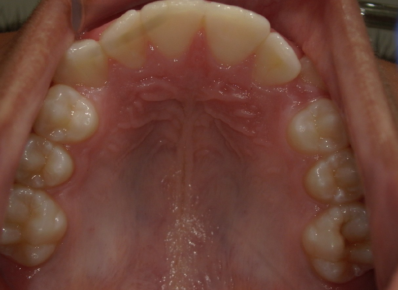 Before treatment