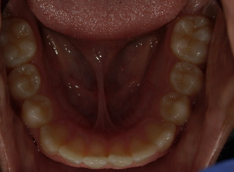 Before treatment