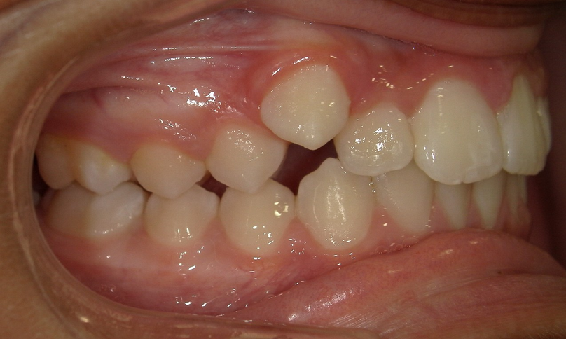 Before treatment