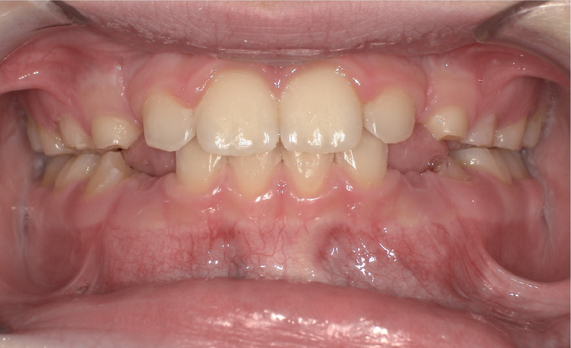 After treatment
