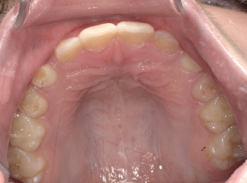 After treatment