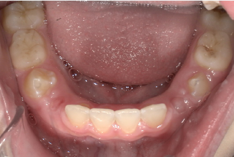 After treatment