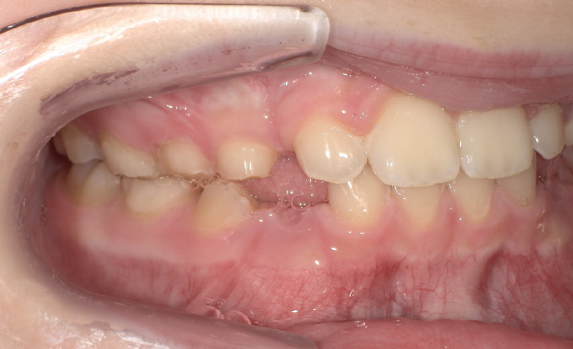 After treatment
